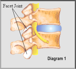 BackMaster - Facet Joints and it's care.